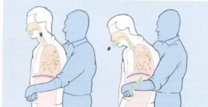 What is the Heimlich Maneuver? How is it done?