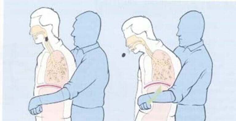 What is the Heimlich Maneuver? How is it done? - CEOtudent