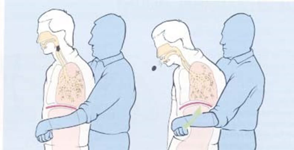 What is the Heimlich Maneuver? How is it done?